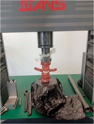 Biomechanical analysis of a novel bone cement bridging screw system combined with percutaneous vertebroplasty for treating Kummell’s disease